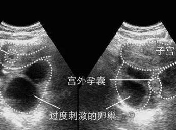 泰国哪里做试管婴儿好些？采用的什么技术？
